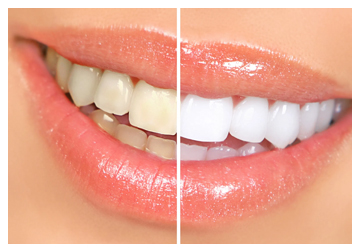teeth-whitening - Addiscombe Dental Surgery